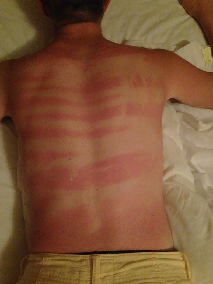 Did Someone Say Bad Sunburn?