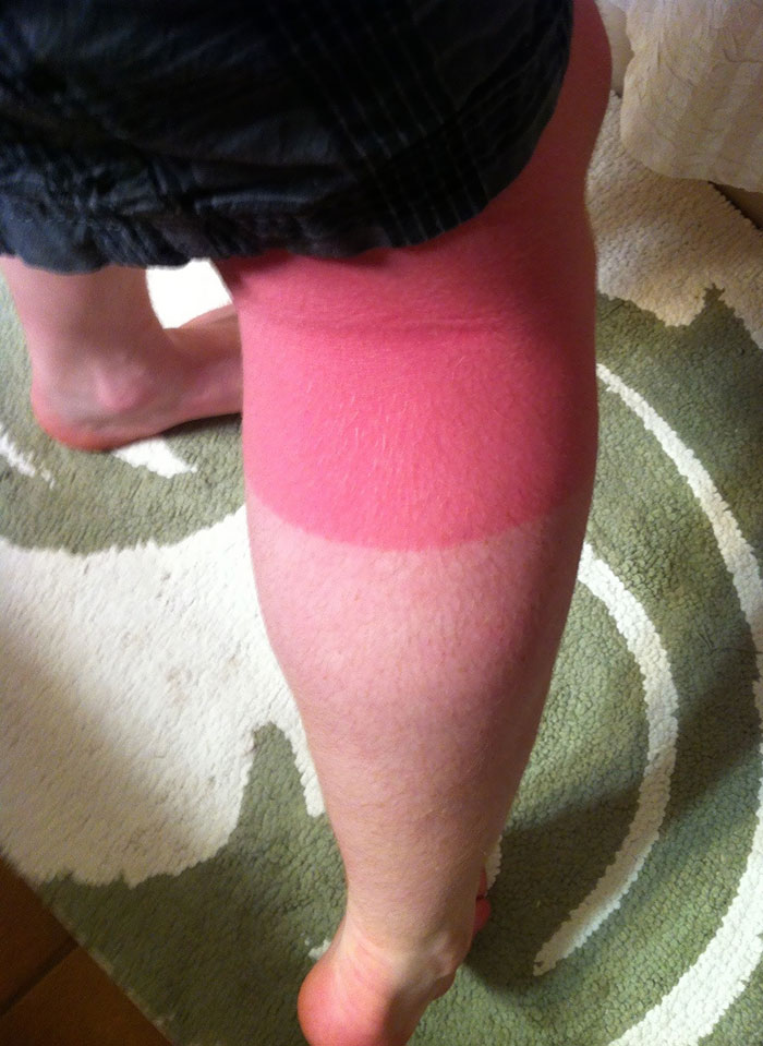Played Soccer. Forgot Sunscreen