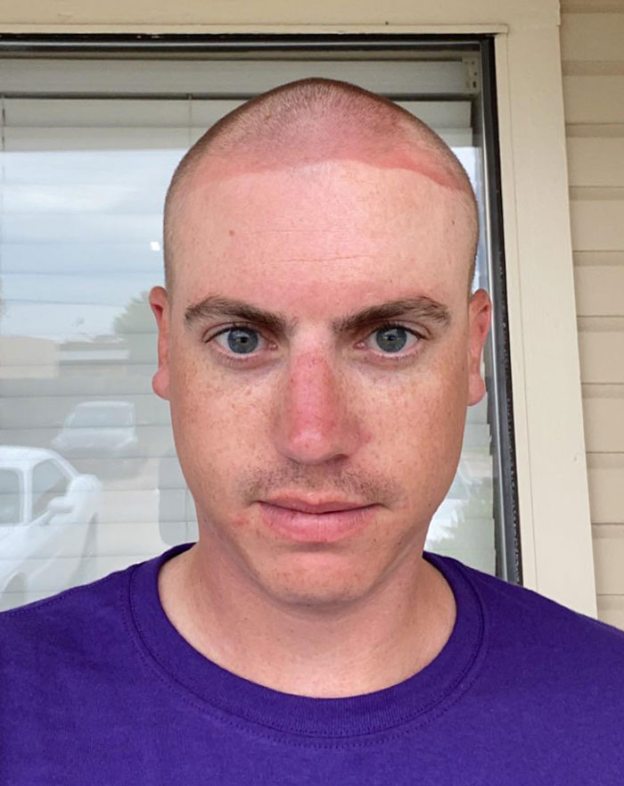 Wore A Bandana Outside All Day After Buzzing My Head And Forgetting That Sunscreen Existed. Got This Sweet Tan Line