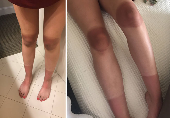 Top Tip - Don't Roll Your Ripped Jeans Up And Then Sit In The Sun For Two Hours Like My Sister Did