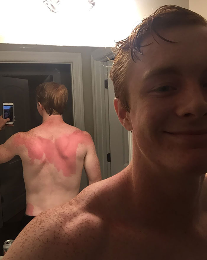 Forgot To Rub In My Sunscreen Today