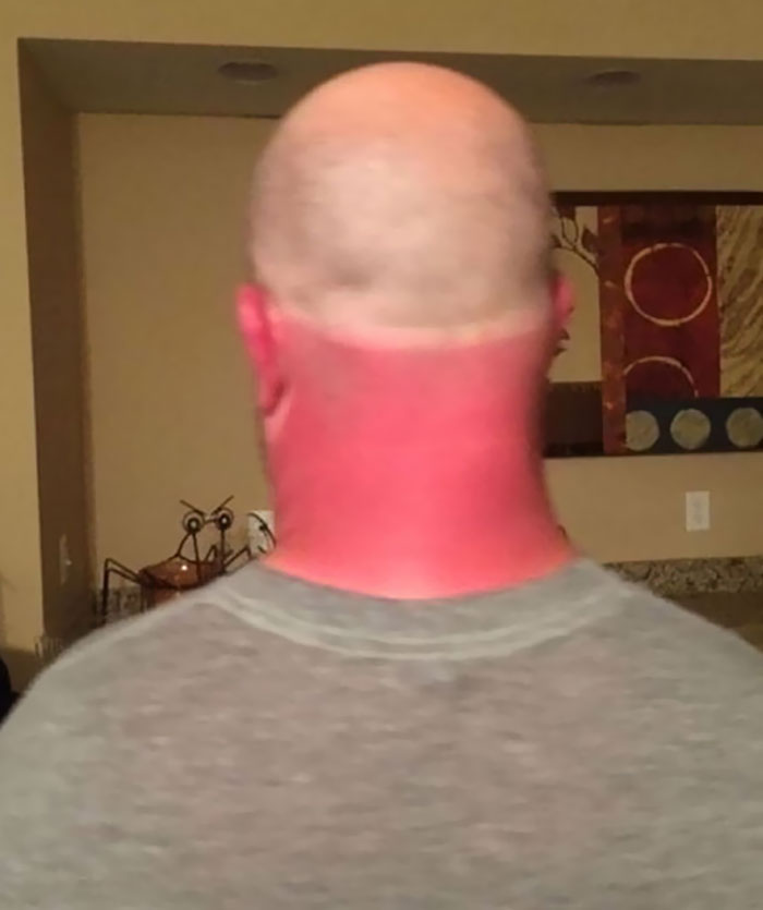 Yea Yea Forgot Sun Screen, But I Wore A Hat