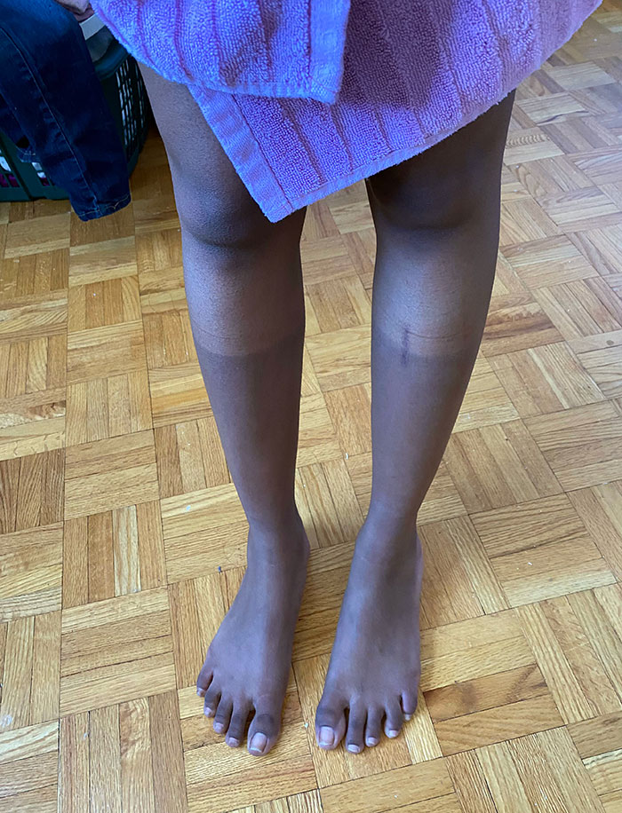 I Spent A Little Too Much Time Outside While Wearing 3/4 Pants