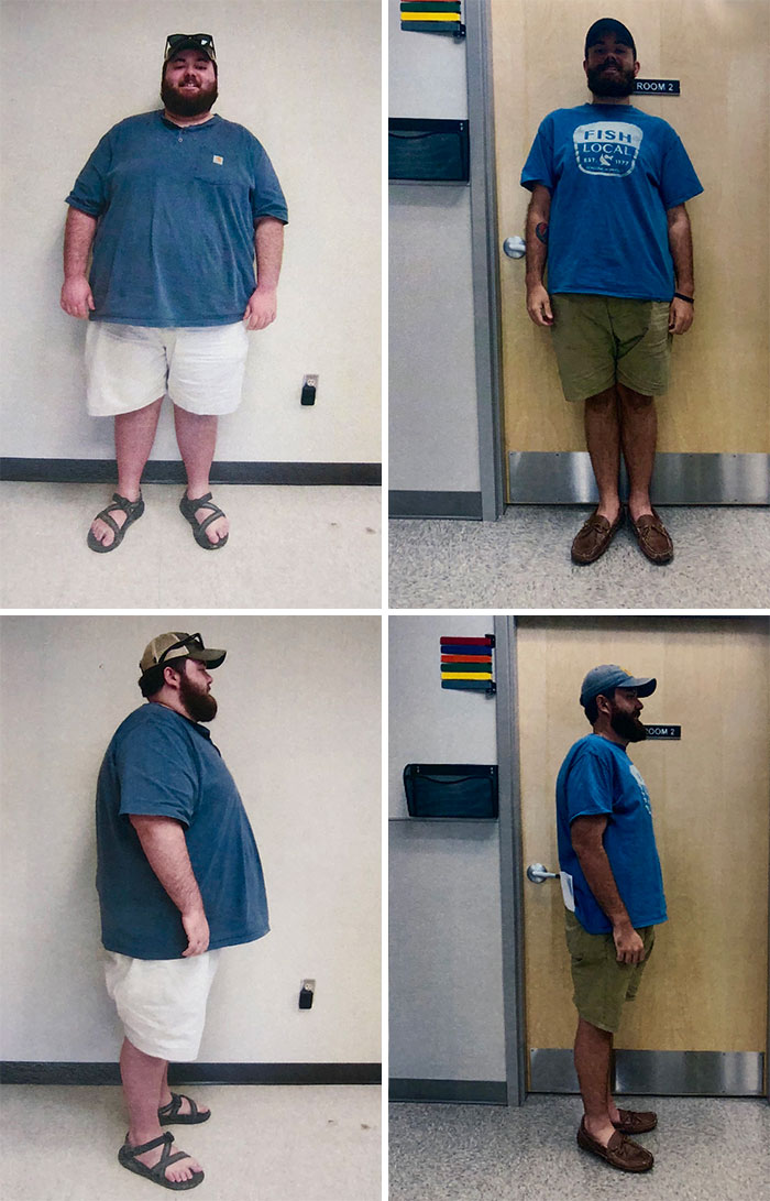 415 Lbs To 218 Pounds In 11 Months. September 4th Will Be A Year