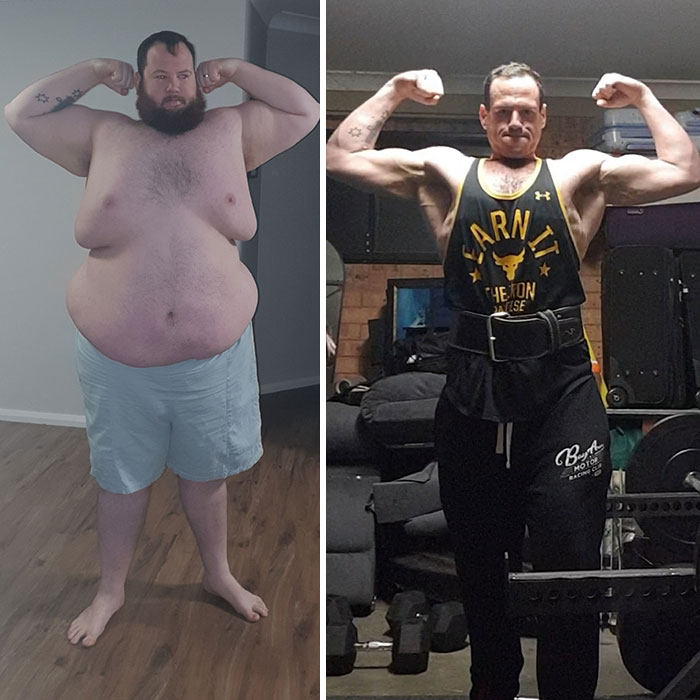 120 Kg Weight Loss 18 Months Loose Skin Pics