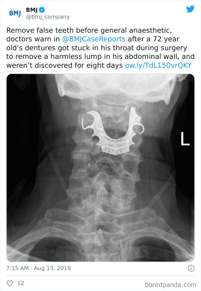 Missing Dentures Found In Man's Throat 8 Days After Surgery