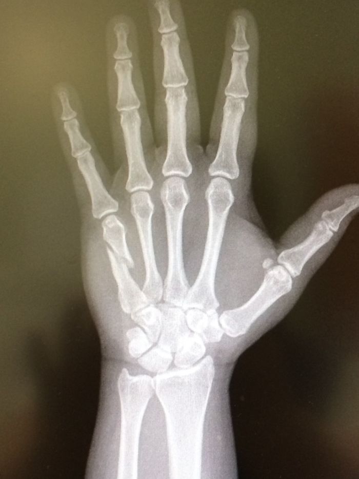 Thought I Had Jammed My Pinky. At The Doc's Office The Next Day, She Told Me To Come With Her To The X-Ray Room And To Bring My Camera