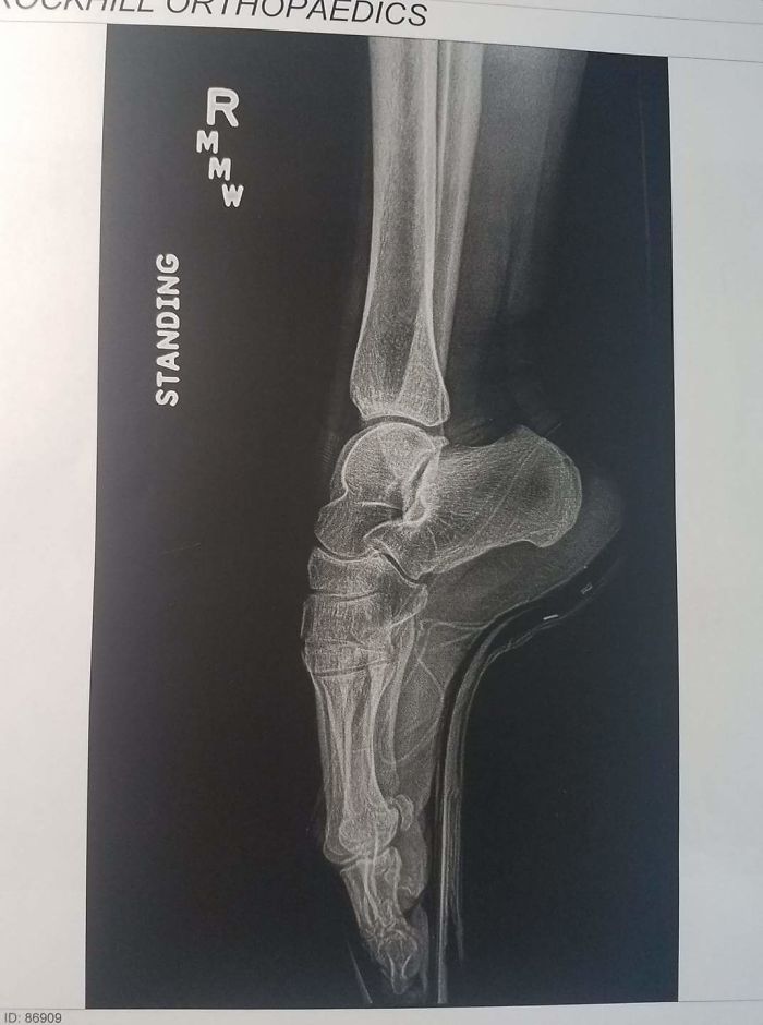 My Wife's A Ballerina, This Is Her X-Ray While En Pointe