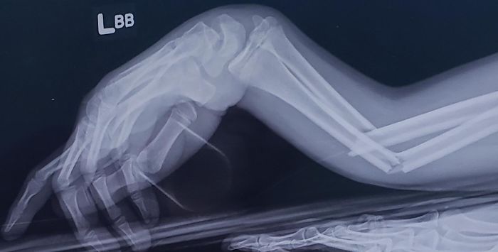 Finally Cropped Out All My Personal Info So, Enjoy This X-Ray