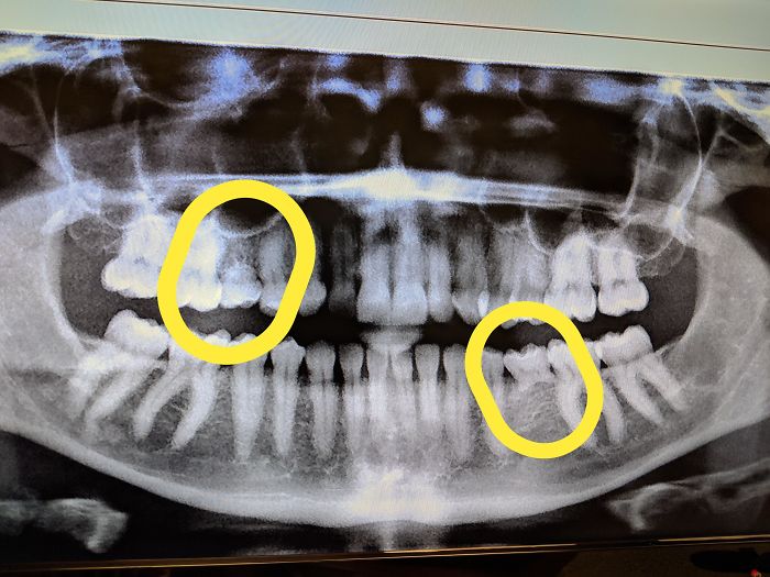 My (33 Year Old) X Rays Showing My Remaining Baby Teeth