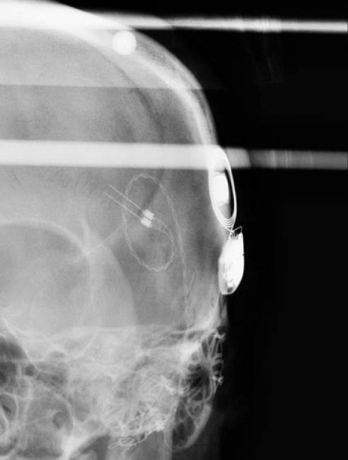 This Is An Xray Of My Old Cochlear Implant. Unfortunately It Didn't Work, So It Was Removed. But It Is Pretty Wild To See All Of The Parts That Were In My Head