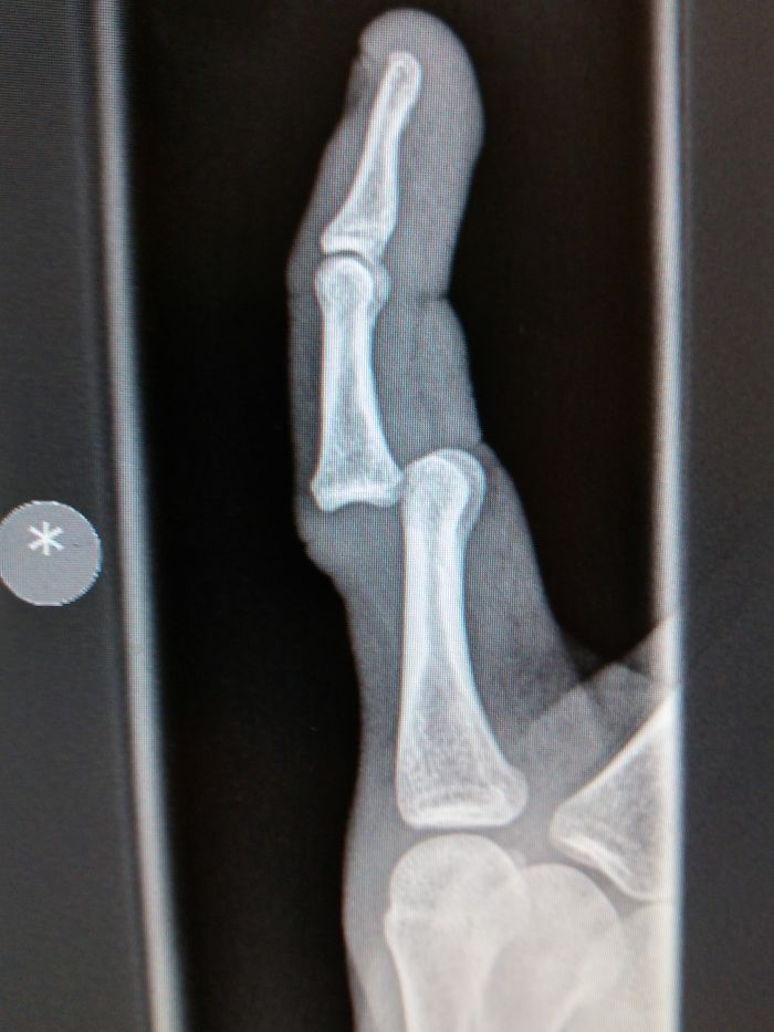 Xray Of My Little Finger Dislocated