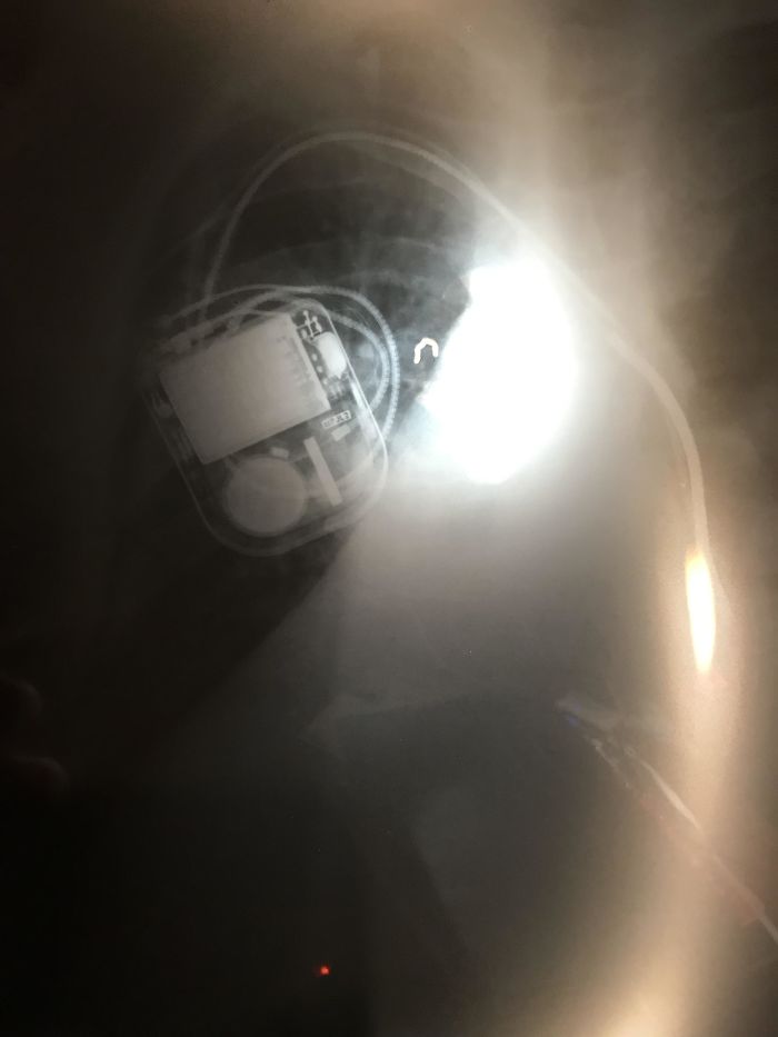 An Old X Ray Of My Pacemaker/Defibrillator. I’ve Since Gotten A New Heart And Don’t Need It Anymore