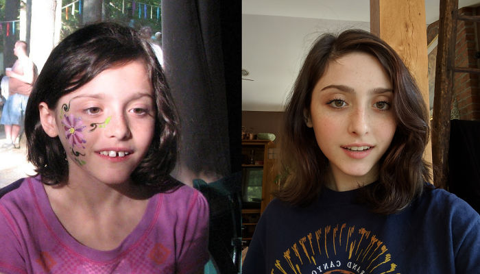 Thank God For The Orthodontist, Me At 10 & 18