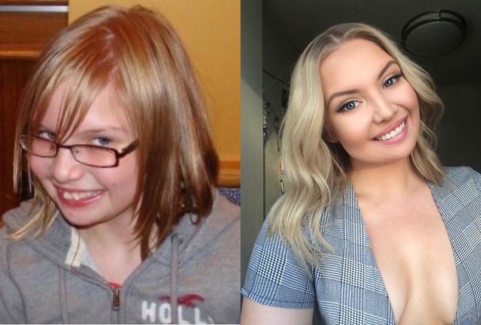 I’m Thankful Braces Exist (12 Yrs To 20 Yrs)