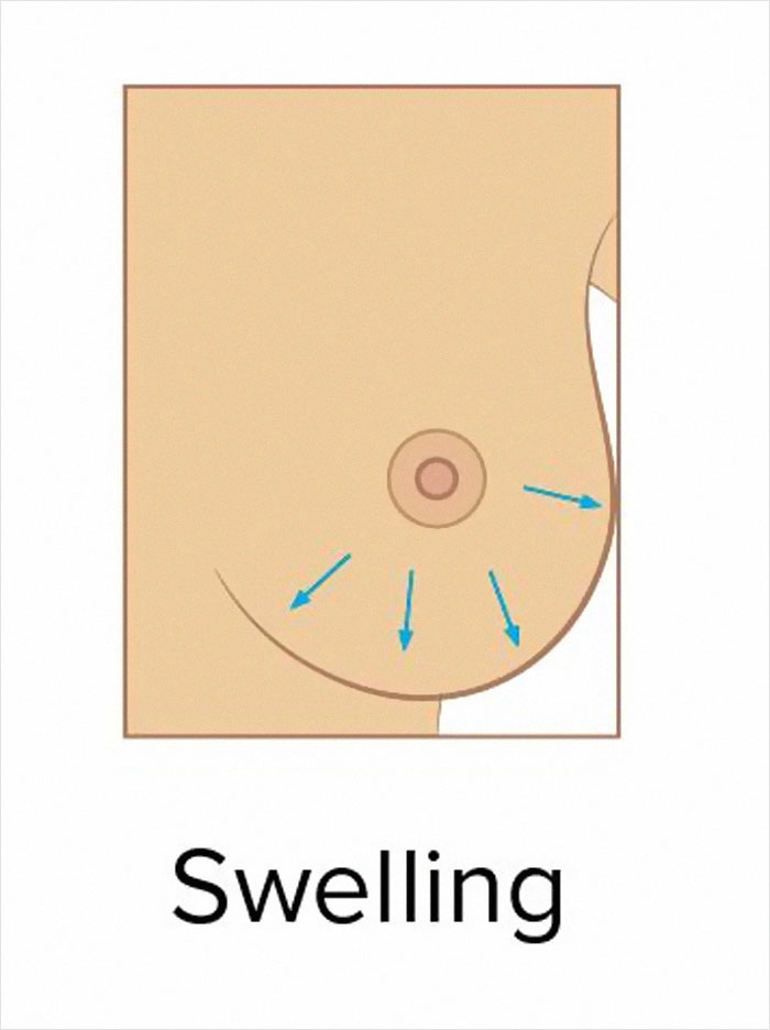 These 9 Pictures Show The Most Common Signs Of Breast Cancer These 9 Pictures Show The Most Common Signs Of Breast Cancer