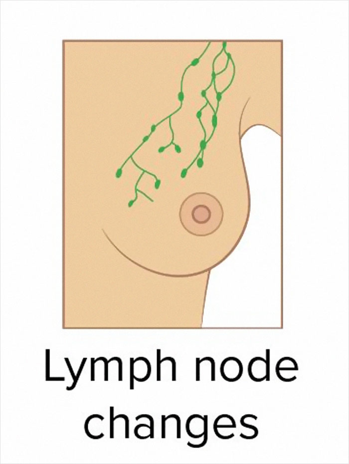 These 9 Pictures Show The Most Common Signs Of Breast Cancer These 9 Pictures Show The Most Common Signs Of Breast Cancer