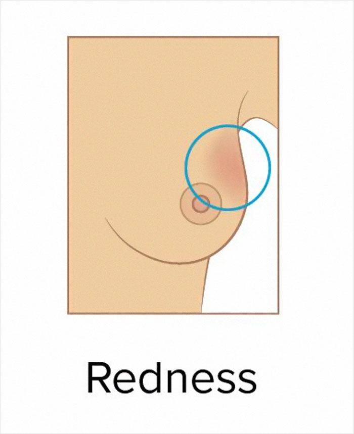 These 9 Pictures Show The Most Common Signs Of Breast Cancer These 9 Pictures Show The Most Common Signs Of Breast Cancer