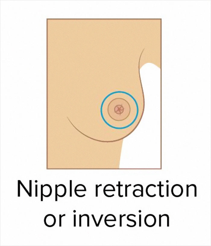 These 9 Pictures Show The Most Common Signs Of Breast Cancer These 9 Pictures Show The Most Common Signs Of Breast Cancer