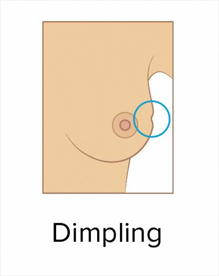 These 9 Pictures Show The Most Common Signs Of Breast Cancer These 9 Pictures Show The Most Common Signs Of Breast Cancer