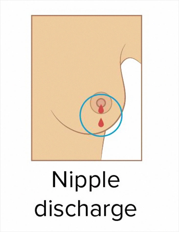 These 9 Pictures Show The Most Common Signs Of Breast Cancer These 9 Pictures Show The Most Common Signs Of Breast Cancer