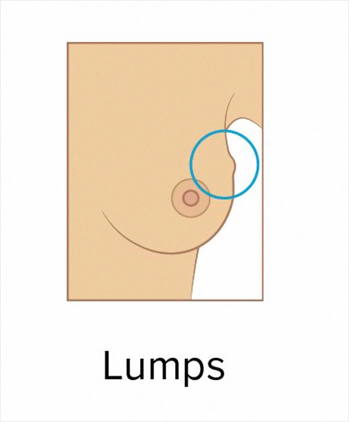 These 9 Pictures Show The Most Common Signs Of Breast Cancer These 9 Pictures Show The Most Common Signs Of Breast Cancer