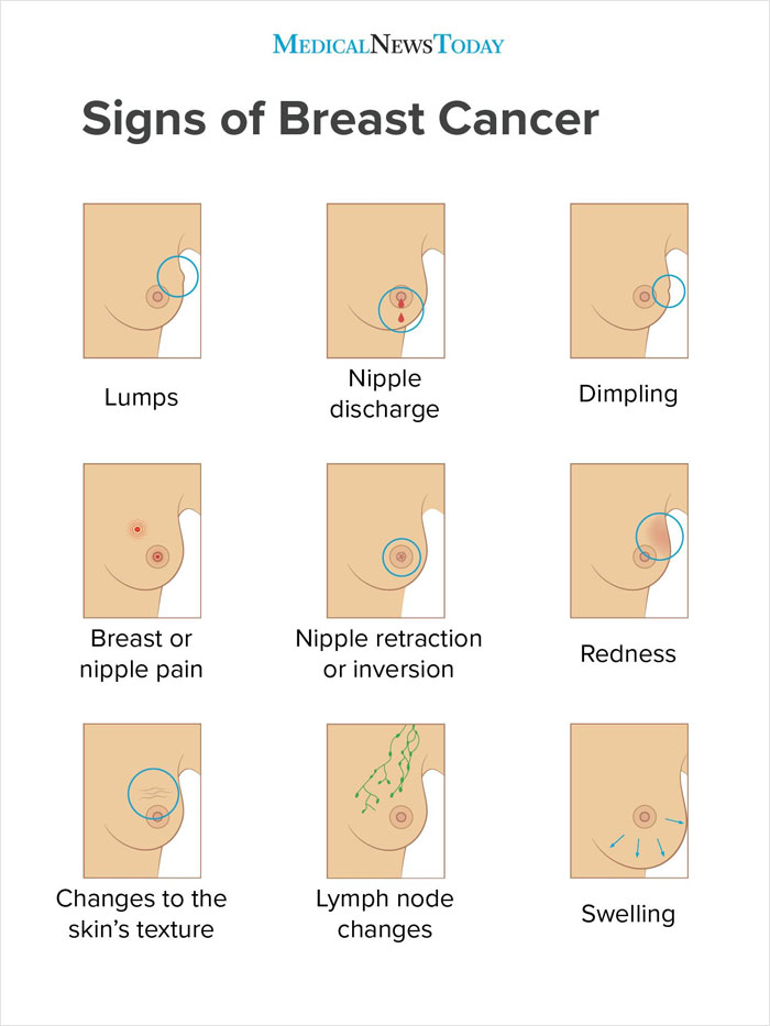 These 9 Pictures Show The Most Common Signs Of Breast Cancer These 9 Pictures Show The Most Common Signs Of Breast Cancer