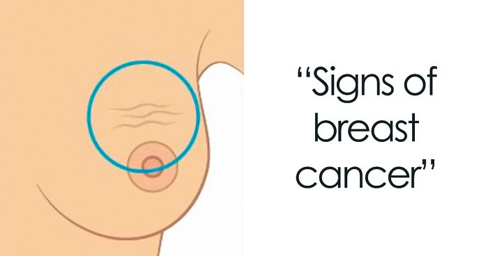 These 9 Pictures Show The Most Common Signs Of Breast Cancer