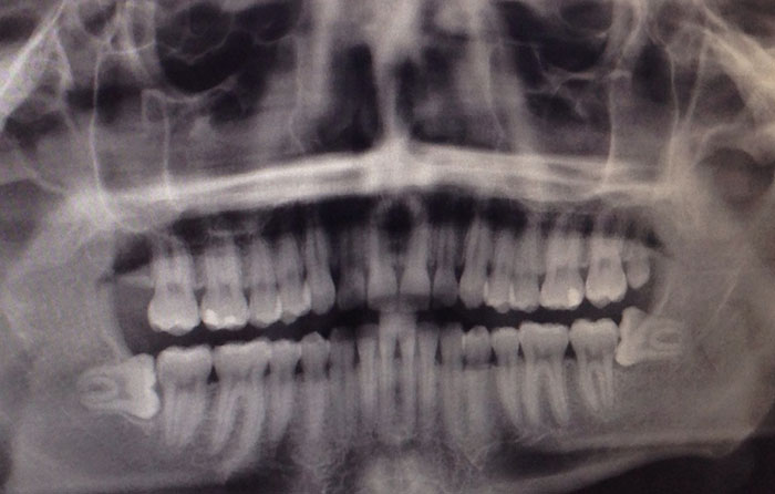 I Went To The Dentist For Tooth Pain, I Got My X-Rays Taken And The Dental Assistant Said My Wisdom Teeth Were "Like Something Out Of A Textbook"