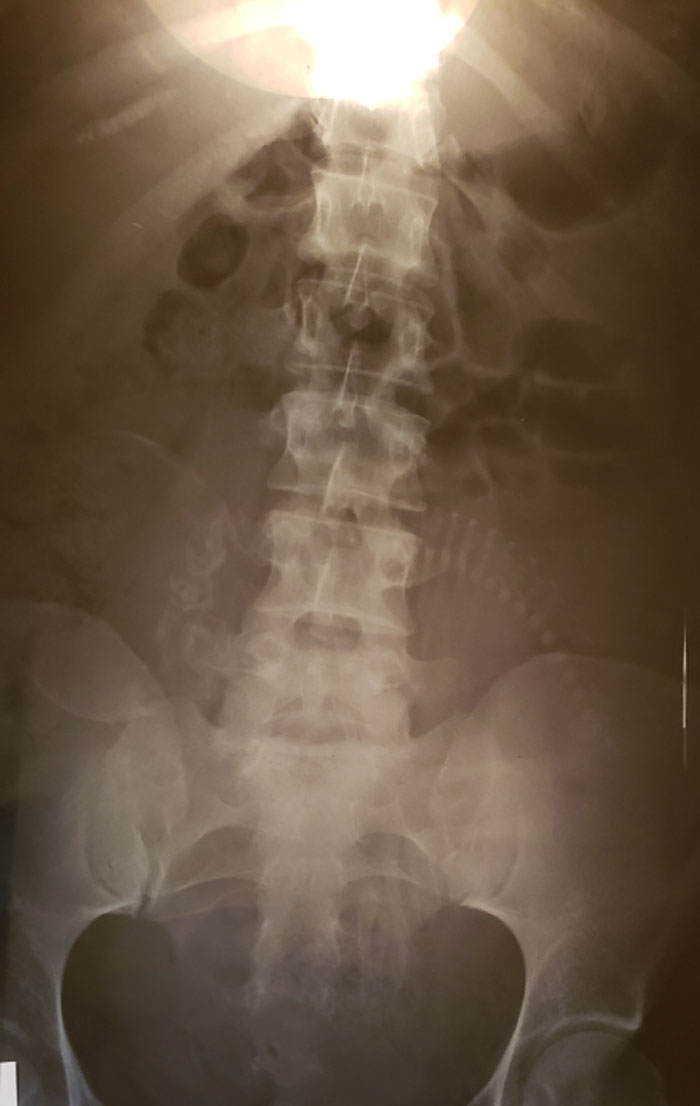 This Xray I Have Of A Pregnant Woman