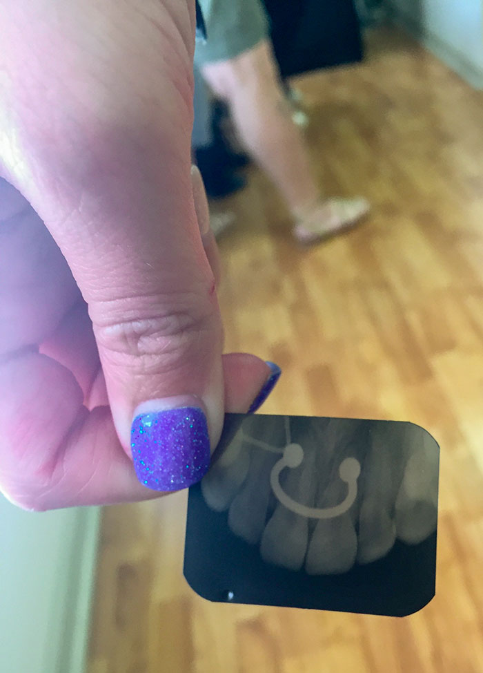 Had My Septum Ring Flipped Up Inside My Nose During An Xray And This Is How The X Rays Came Out