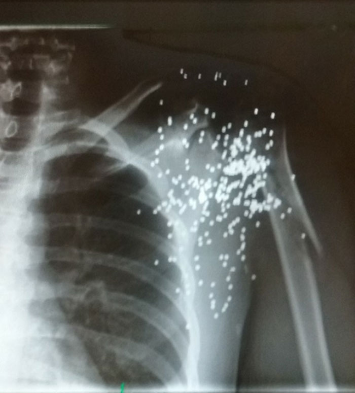 My Friends X-Ray After Being Shot With A Shotgun