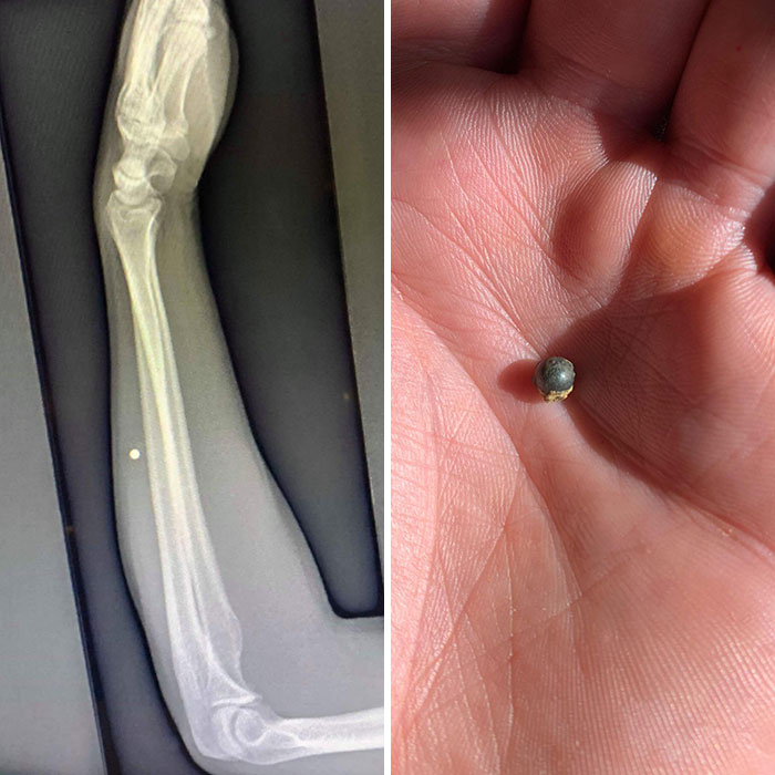 Had A BB Removed From My Arm After 20-ish Years, Here’s The X-Ray And Post Op Culprit