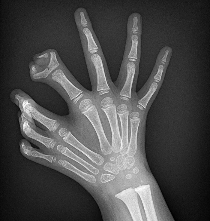 Polydactyl Claw X-Ray
