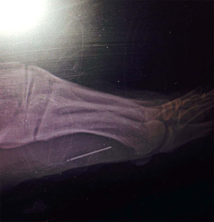 A Woman I Work With Had An X-Ray Done To Her Foot For Her Arthritis... Found This Surprise. Apparently It's Been There For Over 30 Years
