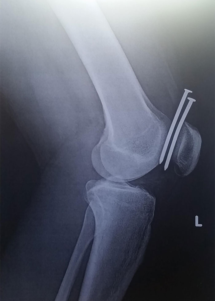 This Guy Had Two Nails From A Nail Gun Hit His Leg, And They Both Missed His Femur And His Kneecap