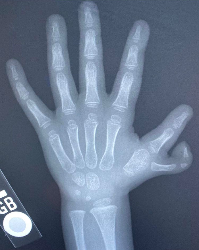 I Give This Post Two Thumbs Up