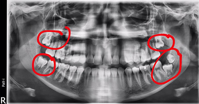 I Have 5 Wisdom Teeth