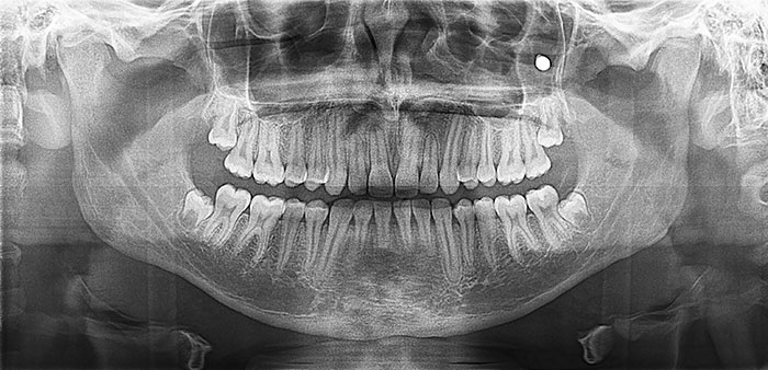 My Son Got Shot In The Face By A BB Gun Two Years Ago (Accidentally). Found The BB Today