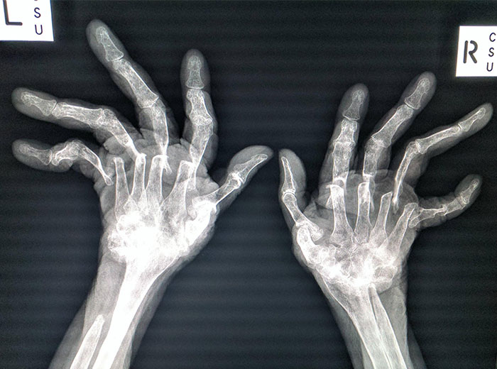 The Worst Case Of Rheumatoid Arthritis I've Ever Seen