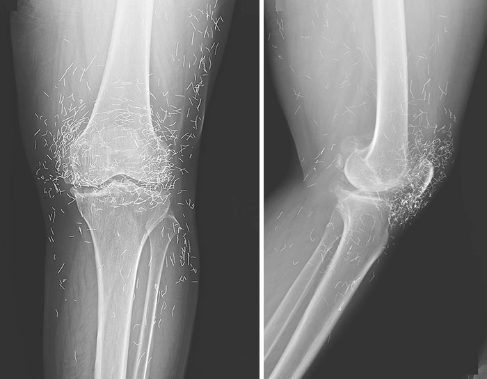 Ineffective Gold Thread Acupuncture Treatment For Osteoarthritis Of The Left Knee