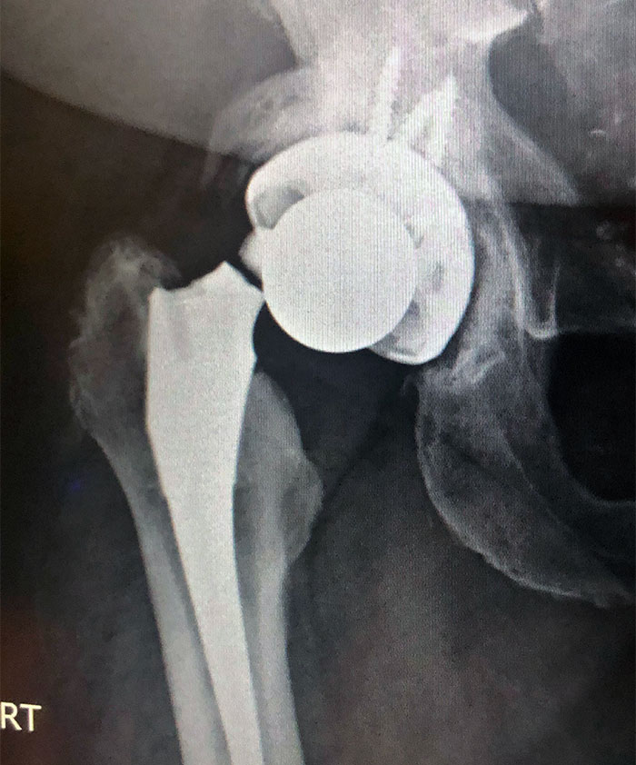 Not Every Day You See A Prosthetic Breaking