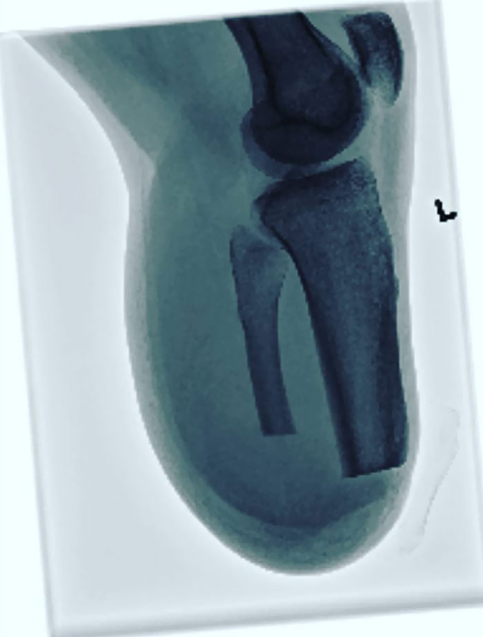 I Finally Got X-Rays Of My Leg After Amputation