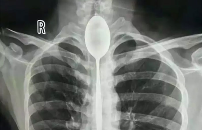 A Man In China Had A Steel Spoon Lodged In His Esophagus For A Year, But Surprisingly, The Half-Swallowed Utensil Didn’t Cause Too Much Discomfort