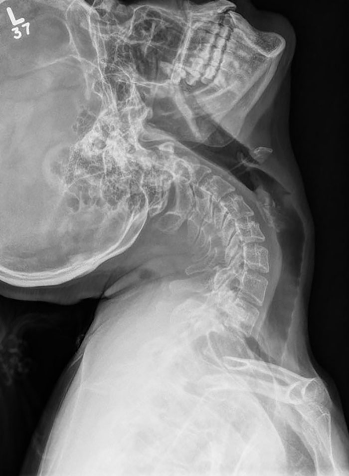 X-Ray Techs Were Amazed At My Cervical Spine Imaging Given Extreme Hyper Mobility