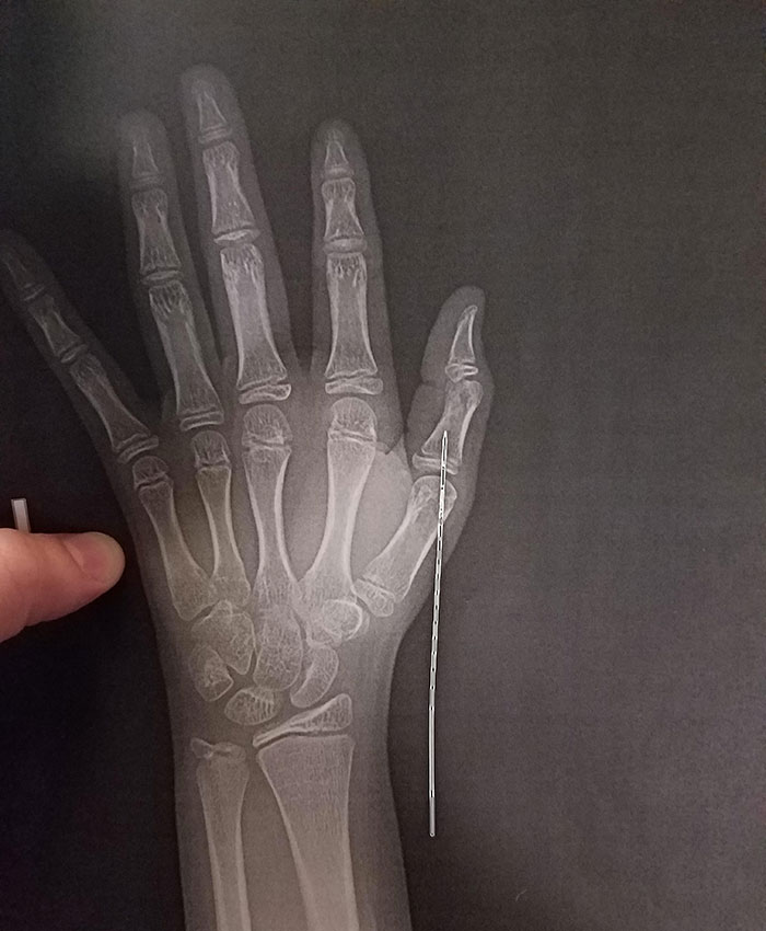 X-Ray Of Blow Dart In My Hand