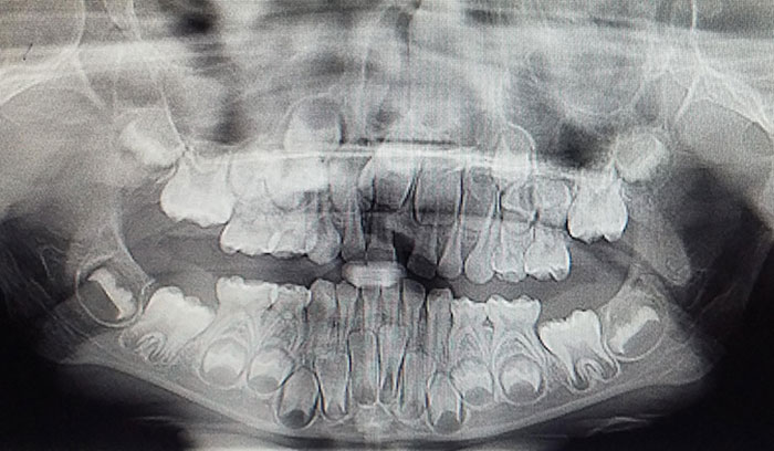 My Daughter's X-Ray Last Year When She Was 5 Years Old. I Was Amazed At Seeing This