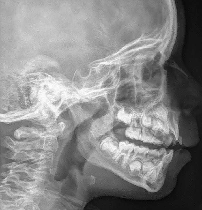 The Extra Row Of Teeth In The X-Ray Of My 7-Year-Old Kid