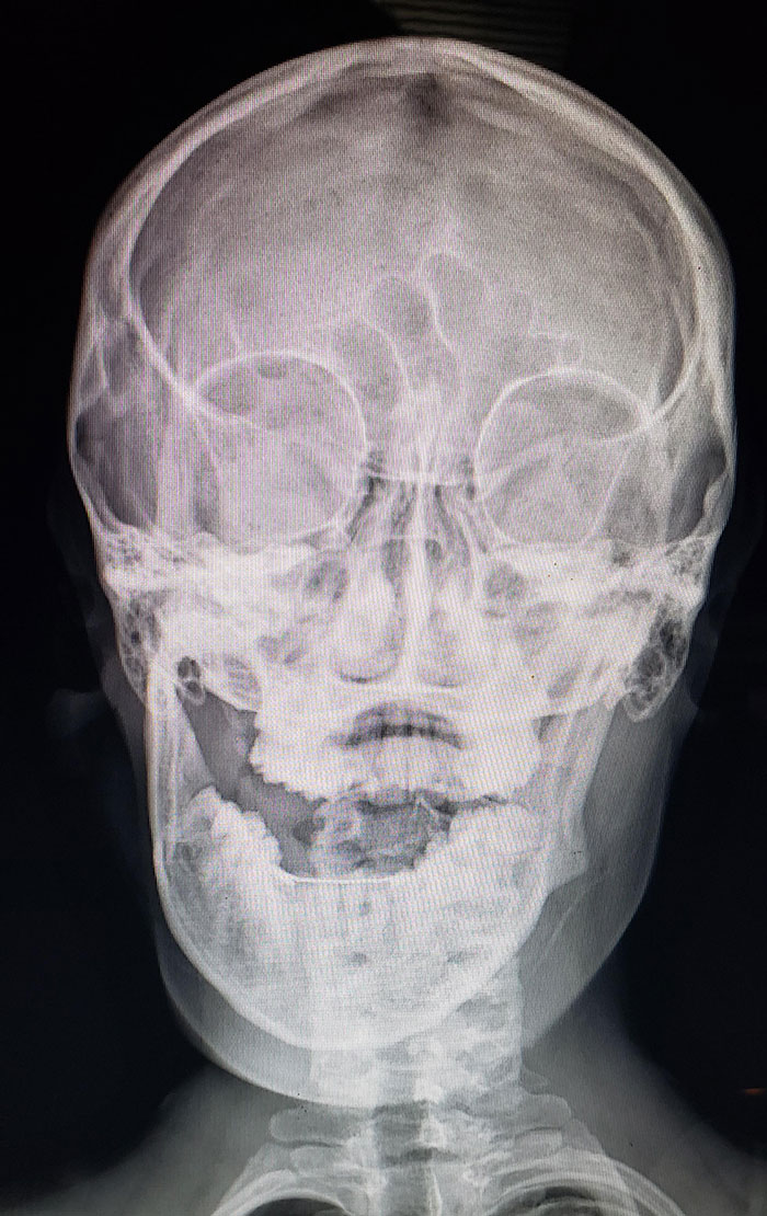 I Dislocated My Jaw... While Eating Cereal