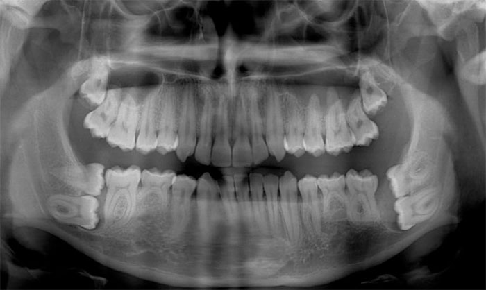 I Took An X-Ray Today And They Told Me That My Wisdom Teeth Are Pretty Strange
